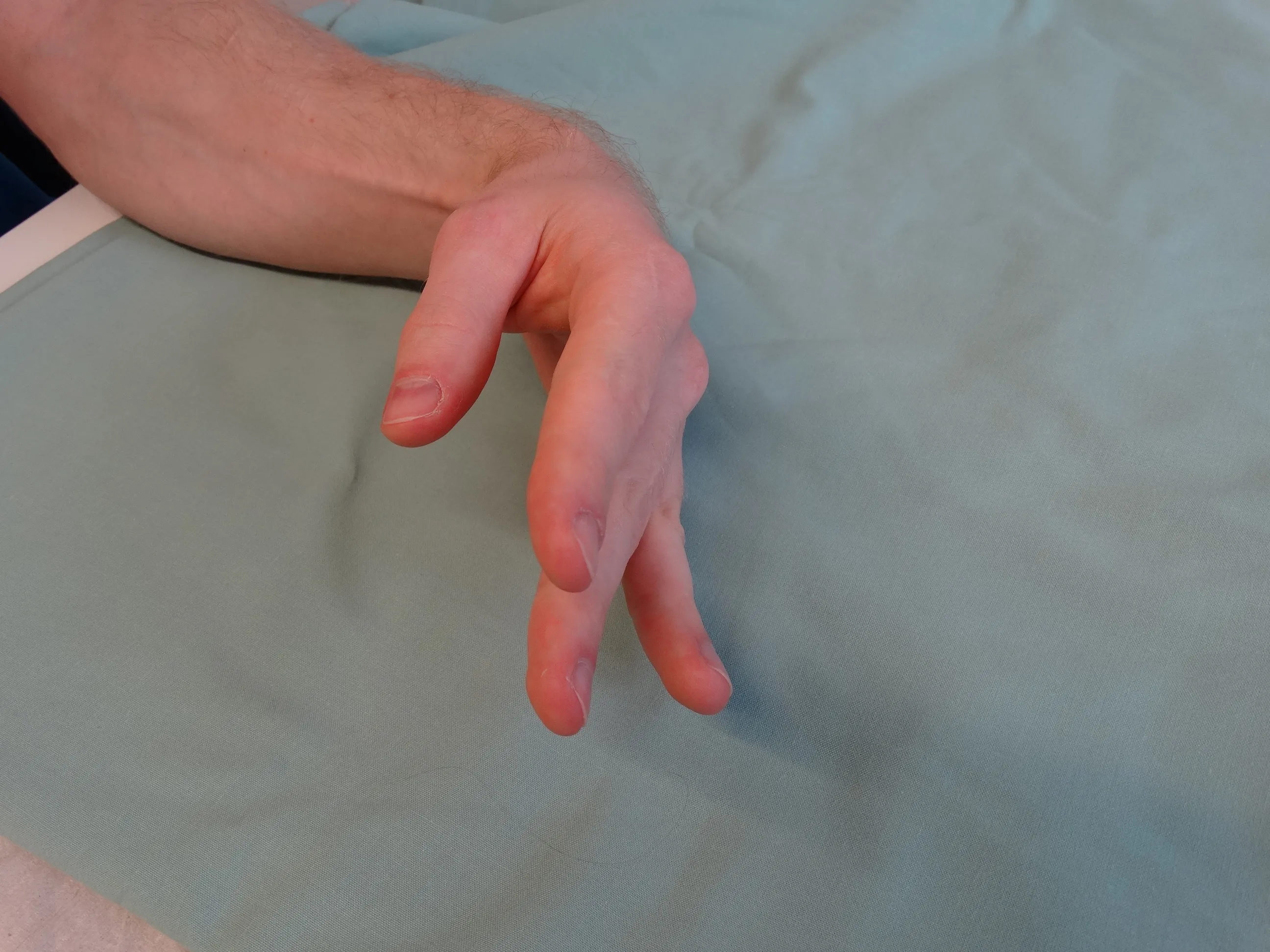 Medizinische Illustration oder klinisches Foto einer Fallhand bei Radialisparese