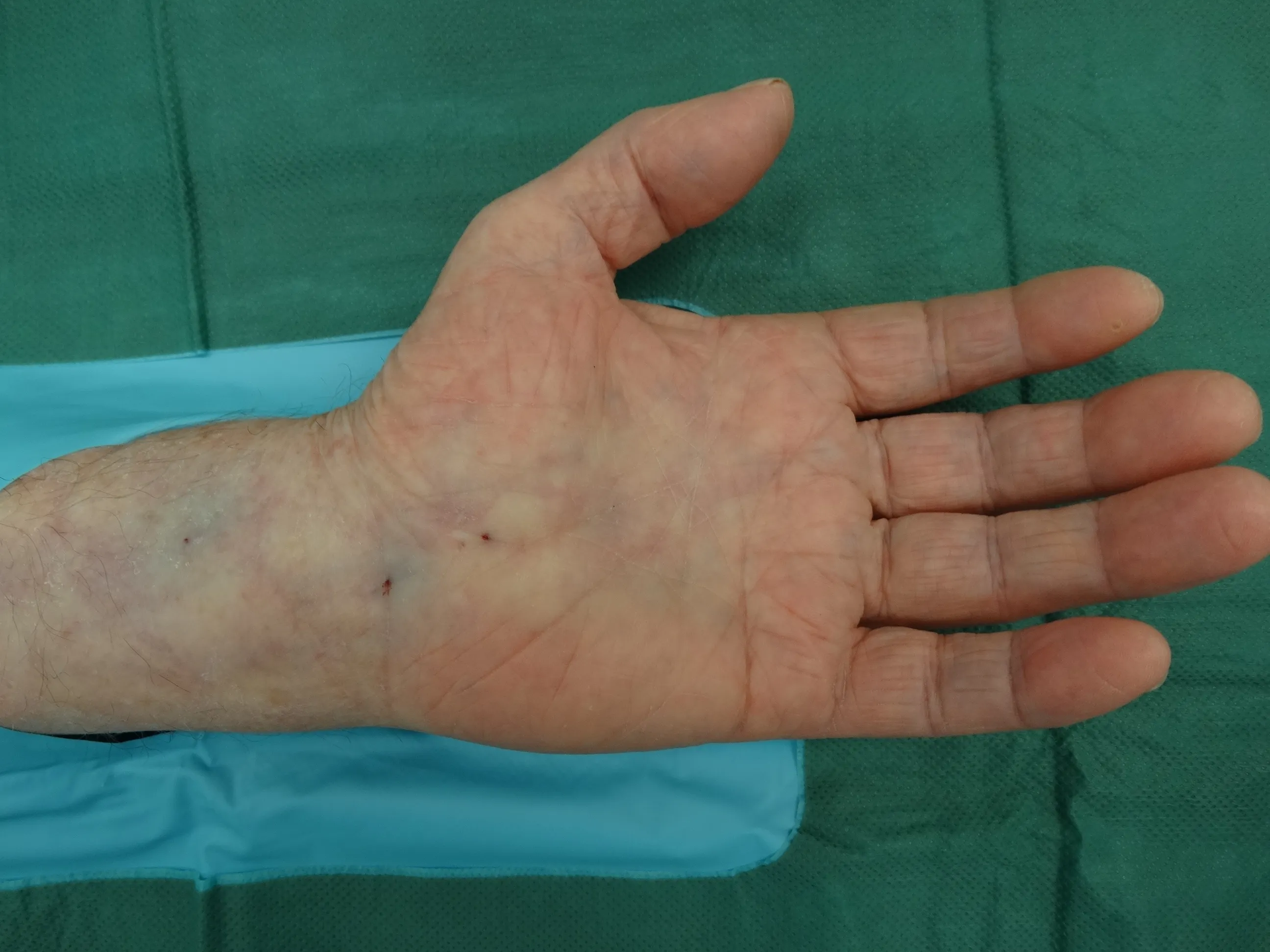 Microsurgical instruments during hand surgery